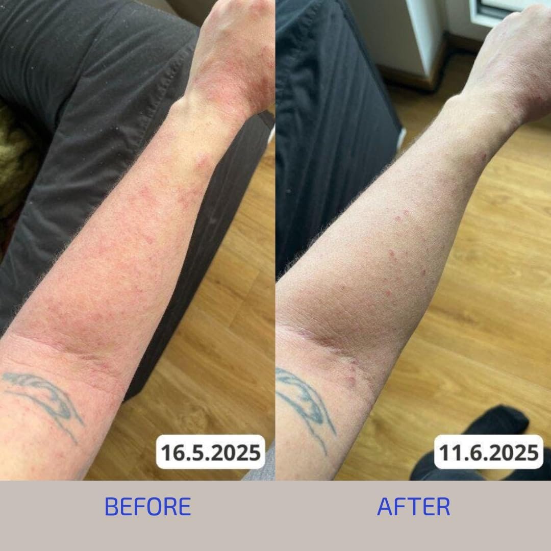 ANTÜ Skin Barrier Repair Supplement – Oral Sachets for Eczema, Rosacea & Psoriasis – Clinically Proven, Vegan, Dermatologist-Tested – Strawberry Lemonade Flavor – 30-Day Supply - Image 6